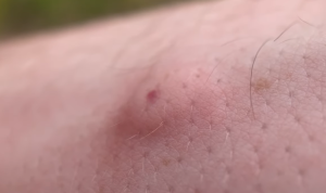 What Does An Assassin Bug Bite Look Likes
